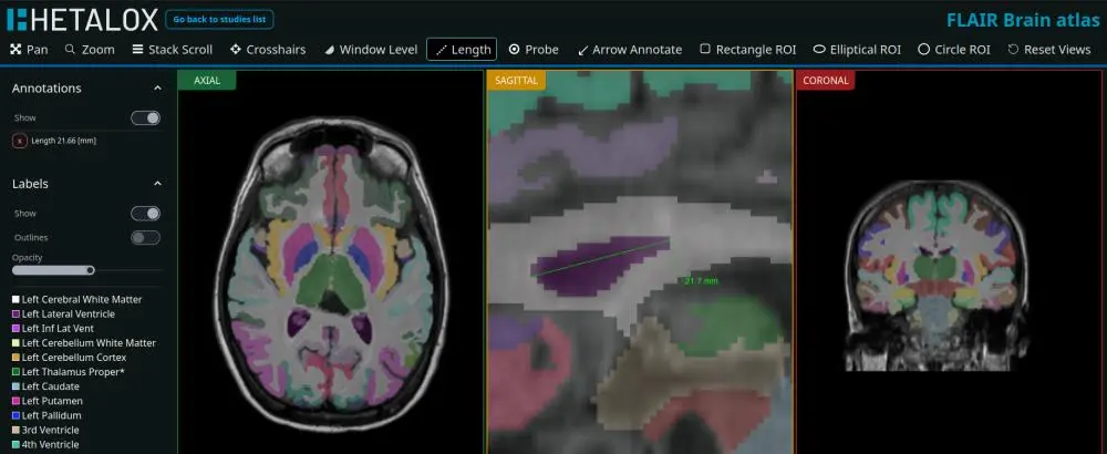 Hetalox demo study viewer