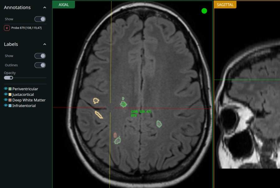 White Matter Hyperintensities Study